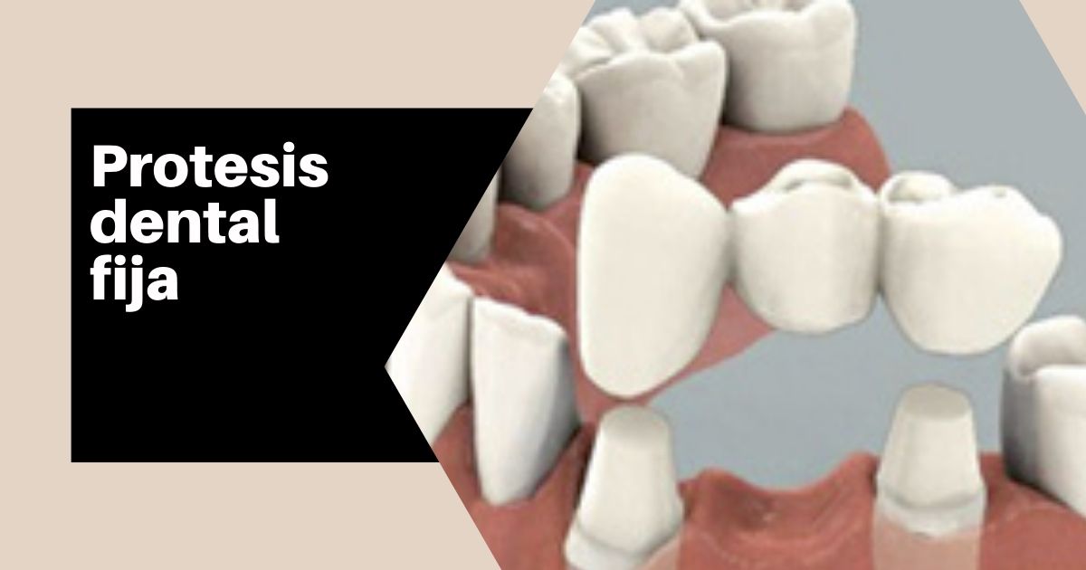 Protesis Parciales Fijas o puentes dentales