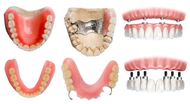 Tipos de Prótesis Dentales en El Salvador, segun su sistema de adhesión