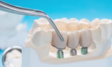 Todo lo que necesitas saber sobre las prótesis fijas sobre implantes dentales